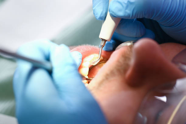 Best Emergency Wisdom Tooth Extraction in Mountain View, HI